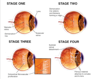 Stages of RETINOPATHY OF PREMATURITY