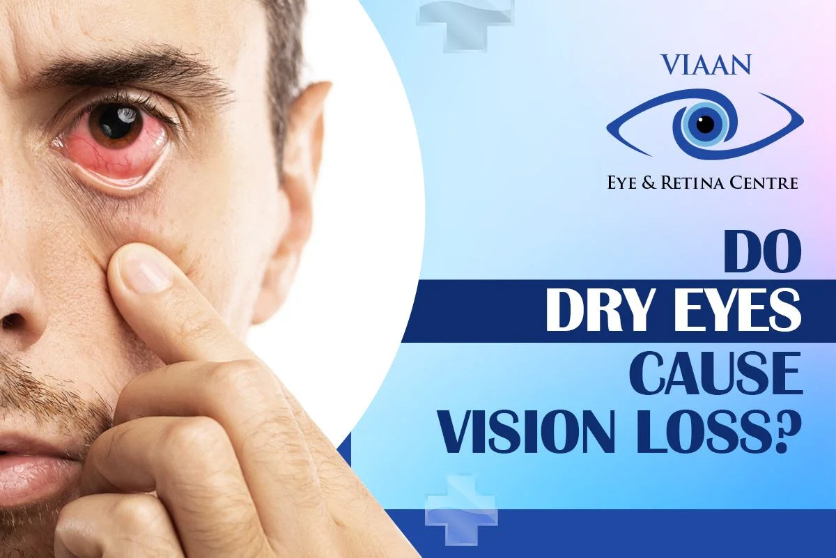 Do Dry Eyes Cause Vision Loss? Defined by the best eye hospital