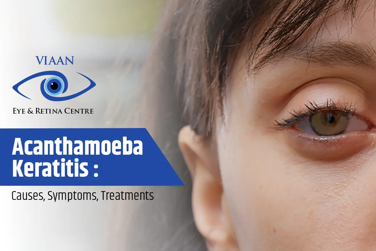 What are the Causes, Symptoms, Treatments, and Precautions of Acanthamoeba Keratitis- Described By Retina Eye Specialist