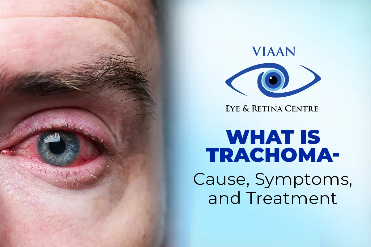 What is Trachoma- Cause, Symptoms, and Treatment Suggested by Retina Eye Specialist