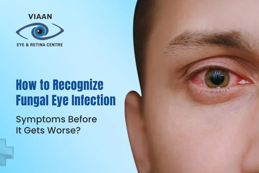 How to Recognize Fungal Eye Infection Symptoms Before It Gets Worse
