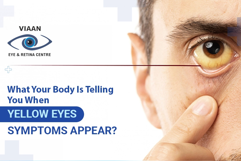 Yellow Eyes Symptoms