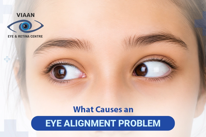 Causes of Eye Alignment Problems