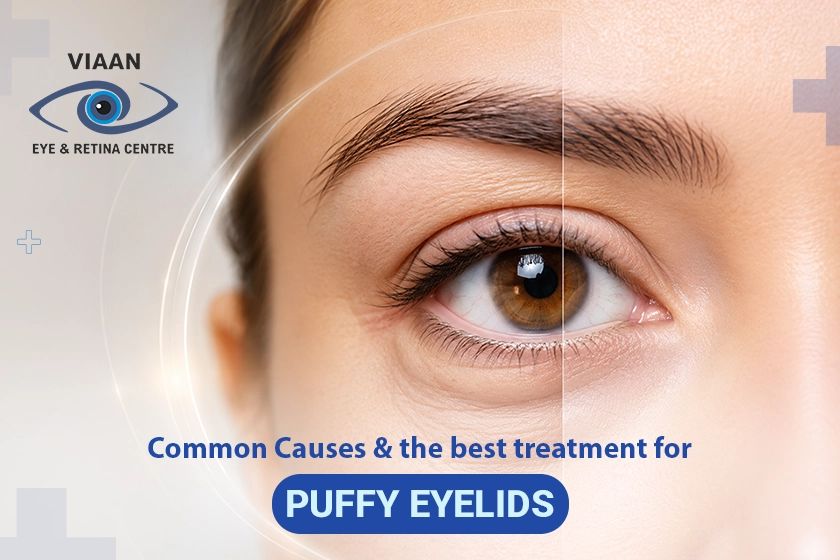 cure for puffy eyelids