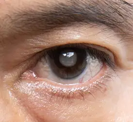 Glaucoma
