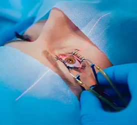 LASIK Surgery