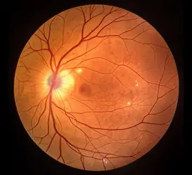 Retina