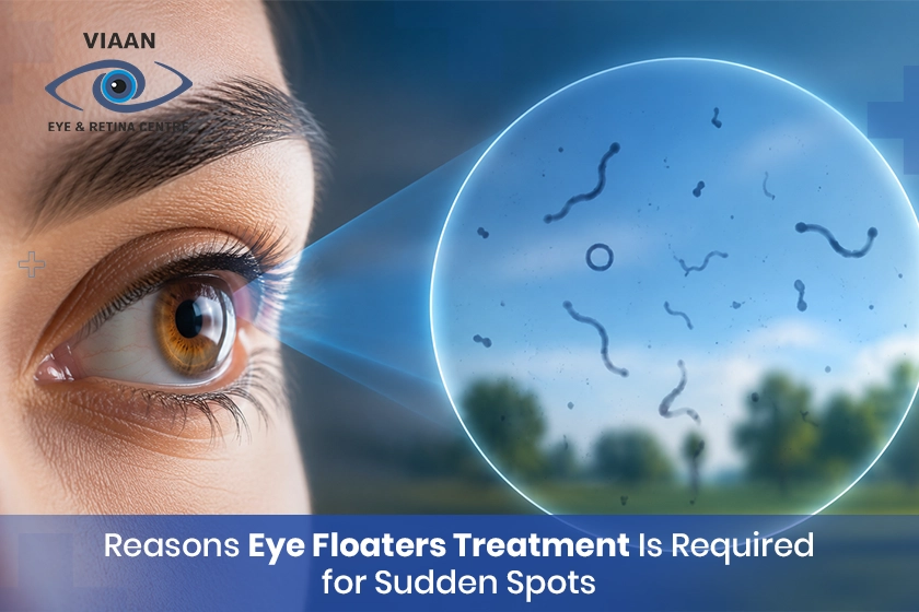 floater eye treatment