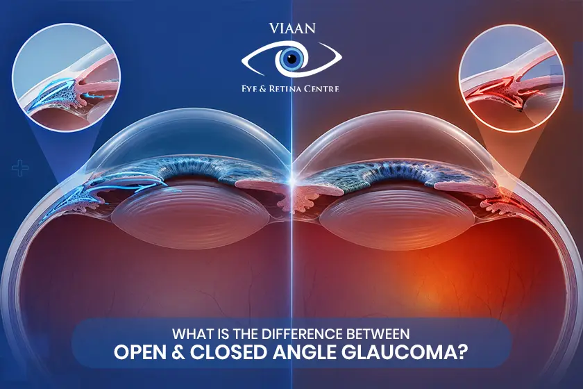 Open and closed angle glaucoma