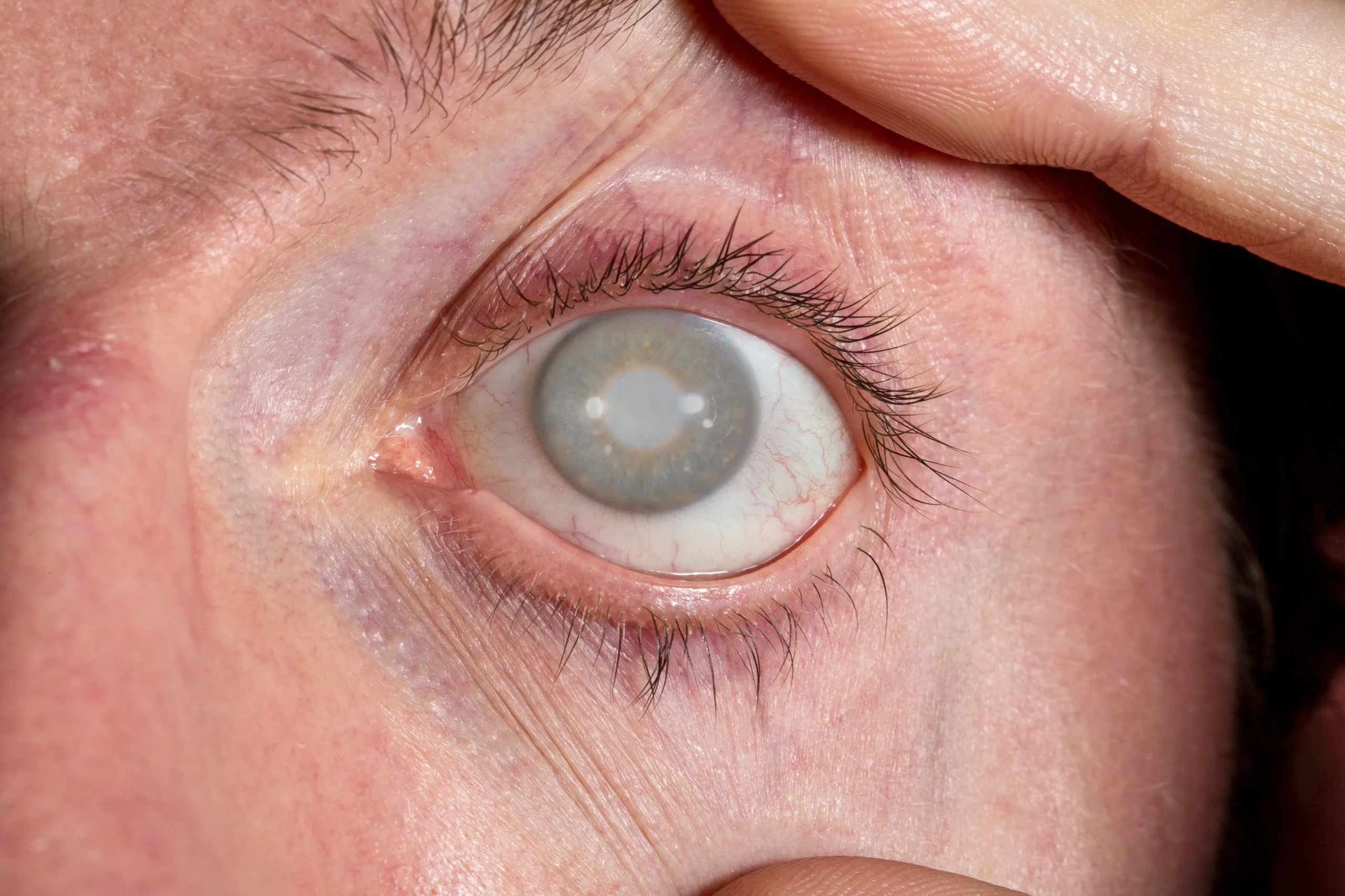 male-eye-with-cataract