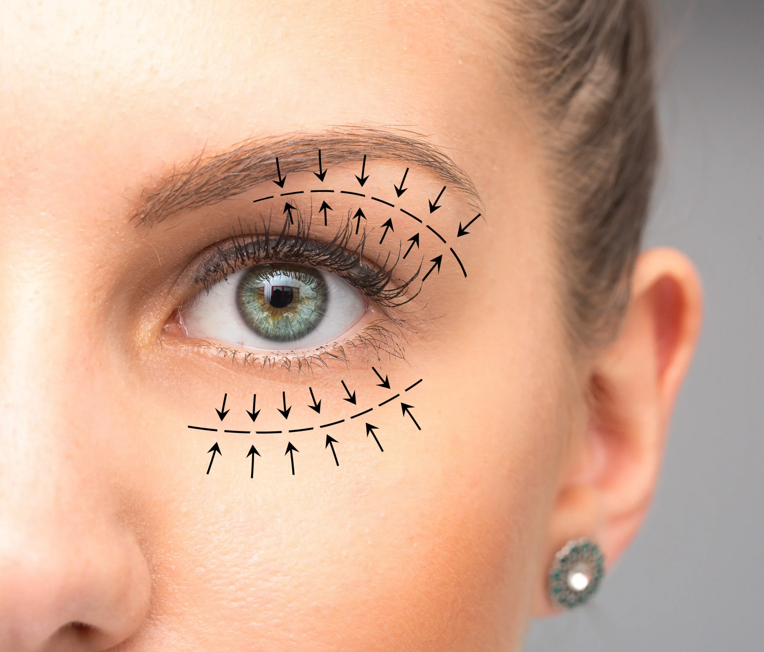 oculoplasty