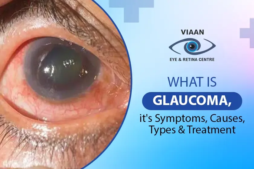 glaucoma’s symptoms and causes